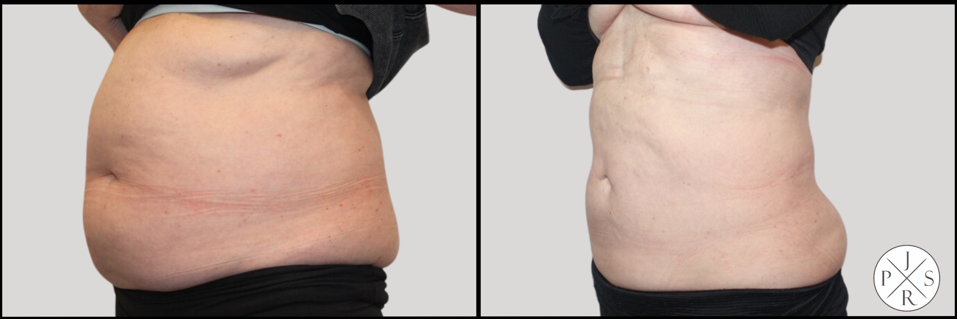 Liposuction Before & After Image